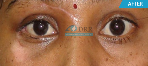Chennai best Treatment for Eye injuries
